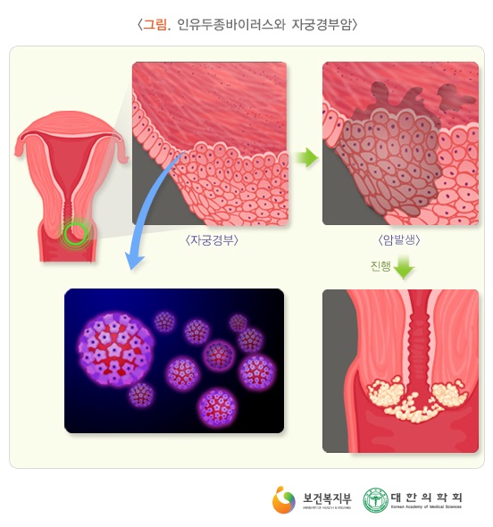10 인유두종 바이러스와 자궁경부암