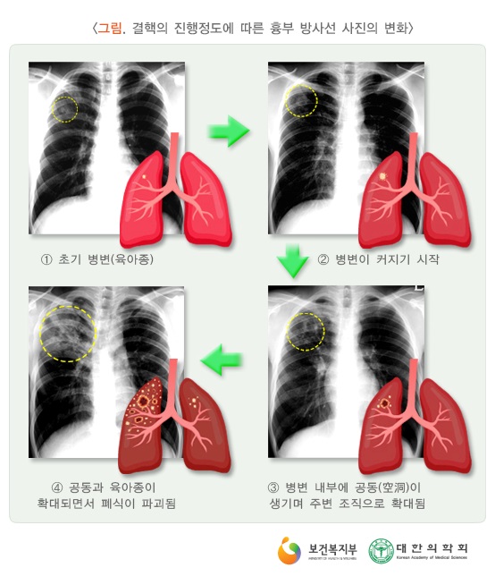 14 결핵의 진행정도에 따른 흉부 방사선 사진의 변화
